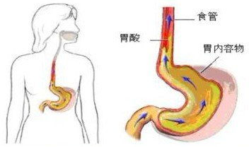 食道炎症状有哪些,识别与应对之道